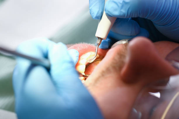 Best Chipped Tooth Repair Near Me  in Upland, CA